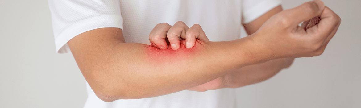 Ar atopinis dermatitas (egzema) išgydoma? 