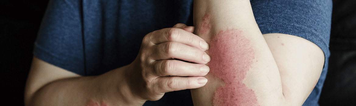 Kaip sukurti tinkamą odos priežiūros planą egzema sergančiai odai