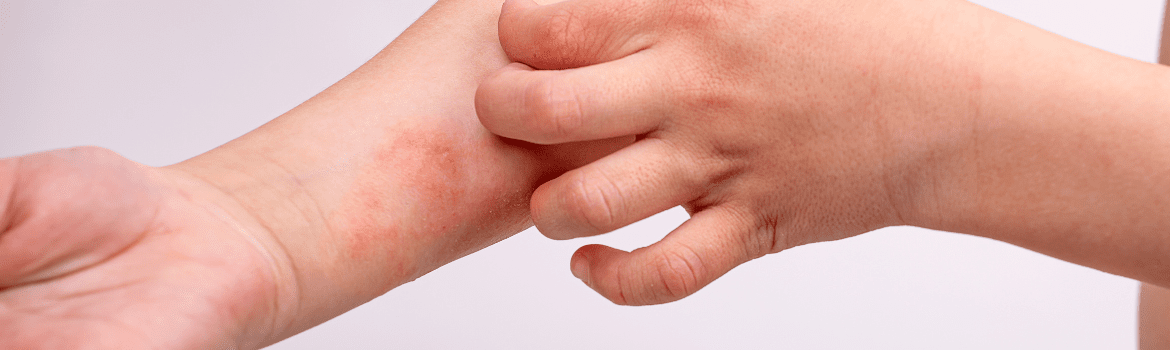 Eczema Skin Care Routine: On Face, Daily, and More