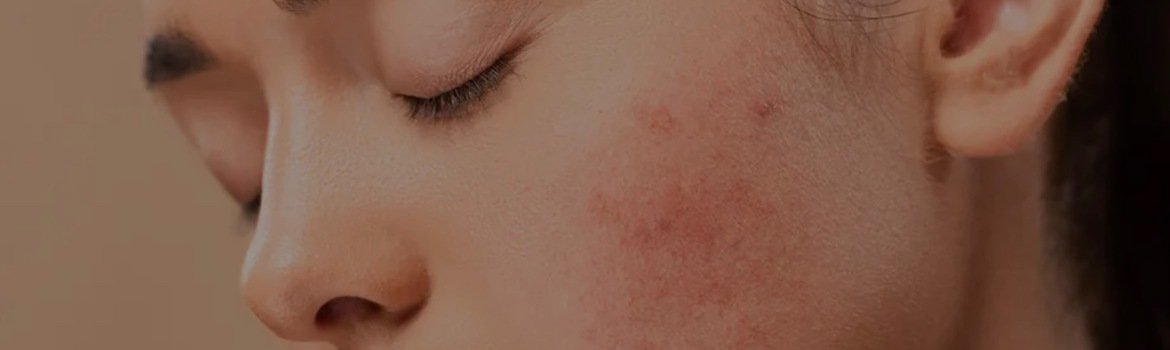 Everything You Want to Know About Acne