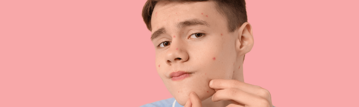 6 patarimai, ką daryti ir ko vengti, gydant paauglystės spuogus