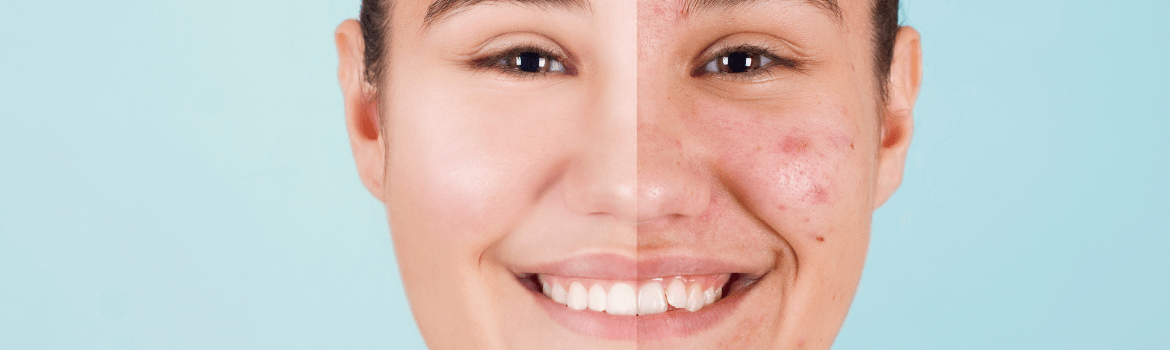 10 spuogų gydymo būdų paaugliams