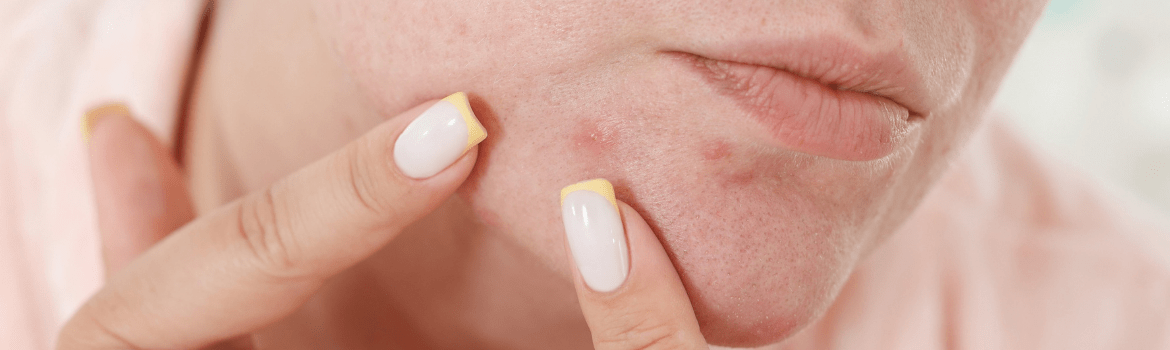 Ką reikia žinoti apie spuogų veido žemėlapius?