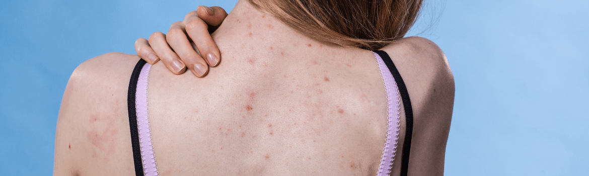 Kaip atsikratyti spuogų ant nugaros?
