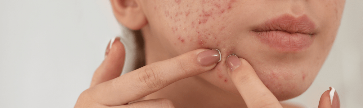 Viskas, ką turėtumėte žinoti apie spuogus ir aknę