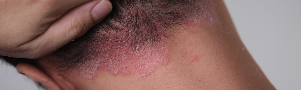 Psoriazė - kas tai yra ir kaip padėti sergančiam