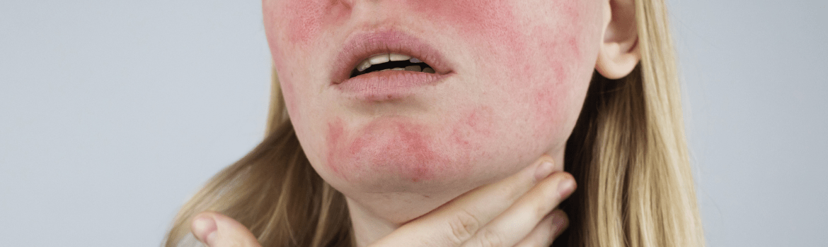 Kuperozė. Kas tai yra ir kaip ją įveikti?