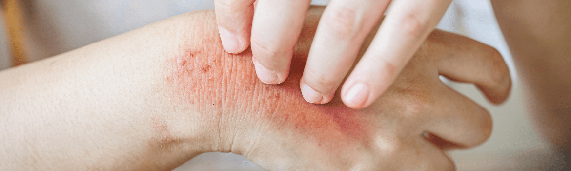 Egzema ir kitos odos problemas. Kodėl jos atsiranda?