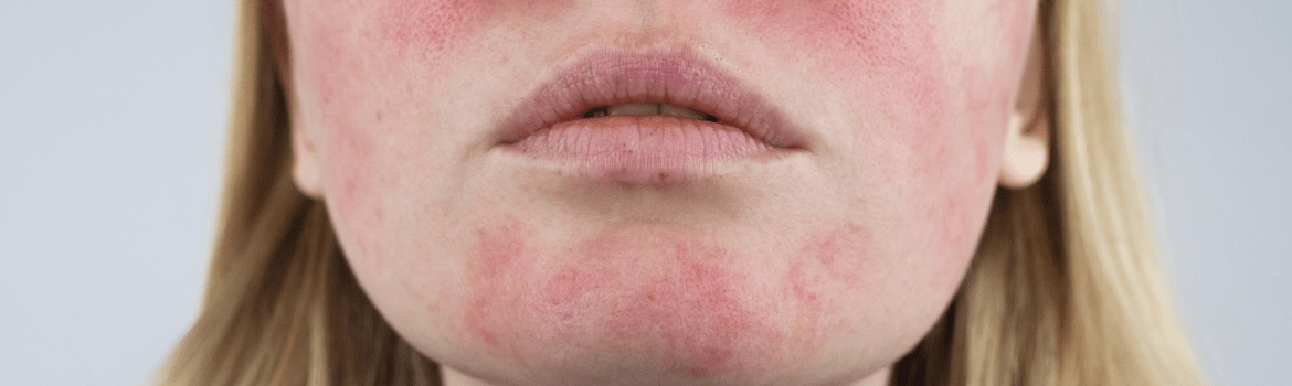 Kas yra veido raudonis ir kaip galime tai koreguoti?