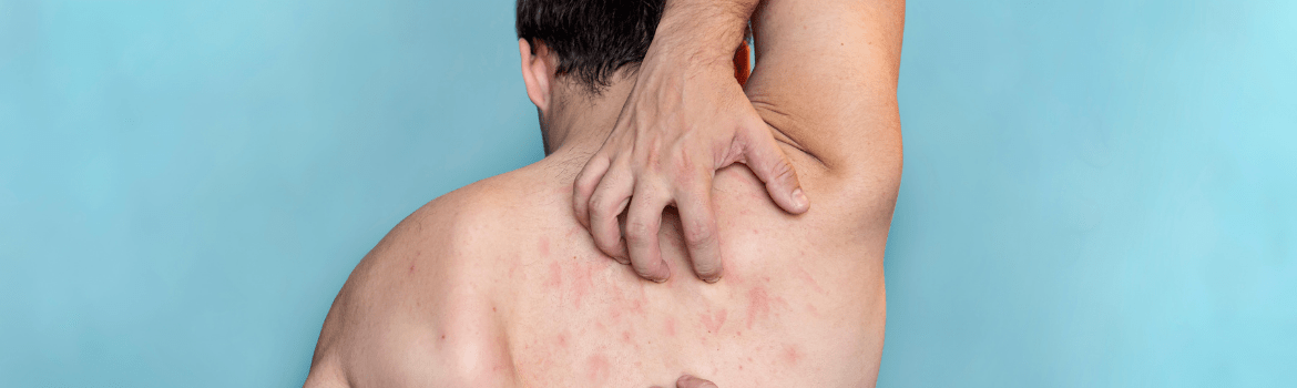 Niežai: ligos signalas ar tiesiog odos dirginimas?