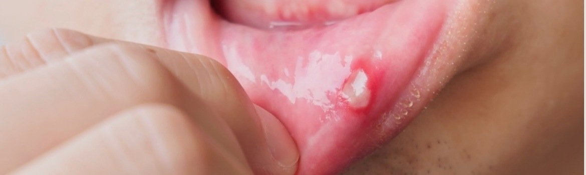 Stomatitis: how to recognize it and what to do?
