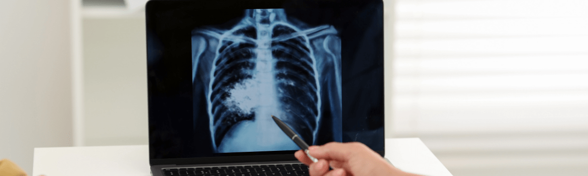 Kodėl tuberkuliozė yra vienas iš didžiausių visuomenės sveikatos iššūkių?