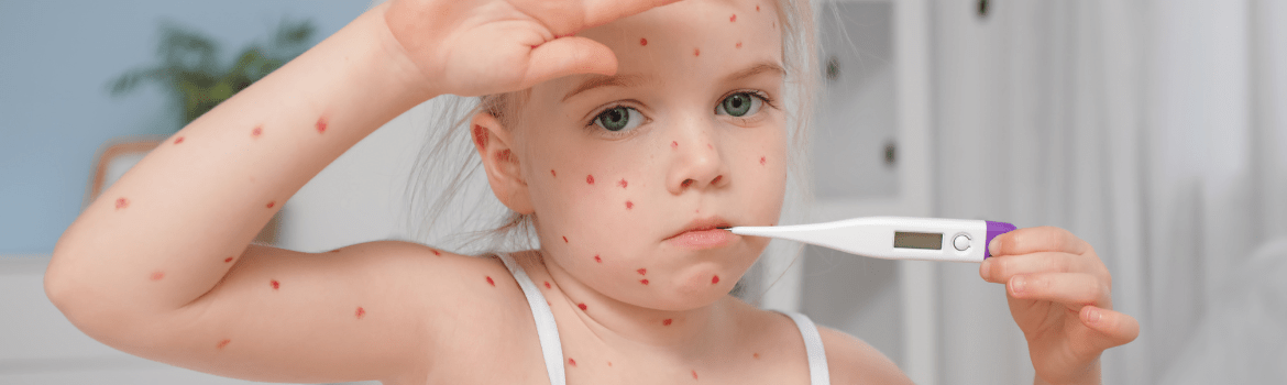 What is chickenpox? Symptoms, spread, and prevention methods