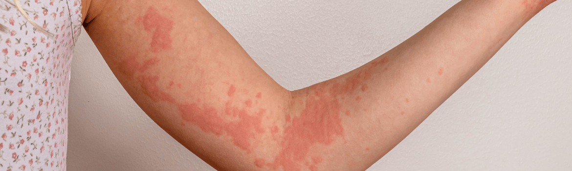 Kodėl dilgėlinė pasikartoja?