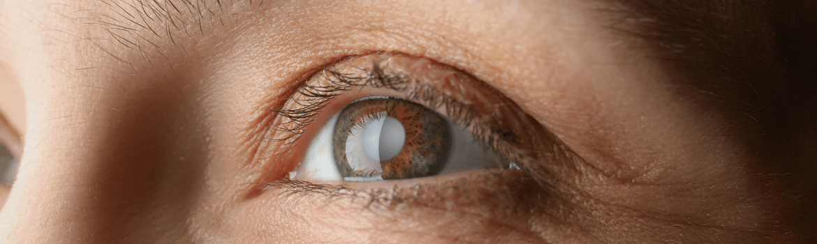 Katarakta. Kas gali sumažinti jos riziką?