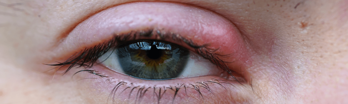 Kas yra miežis? Plačiau apie akių voko uždegimą