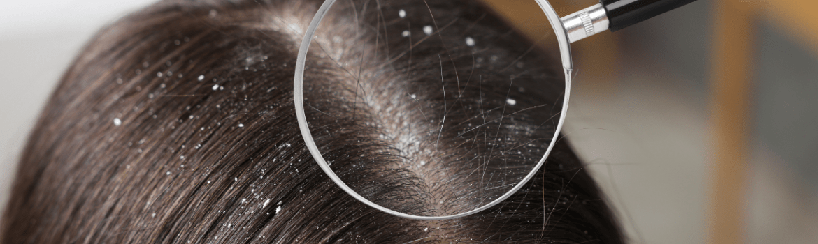 Teisingas plaukų šampūno pasirinkimas nuo pleiskanų