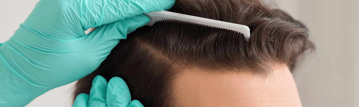 Vyrų ir moterų plaukų slinkimas (alopecija): nuo A iki Z