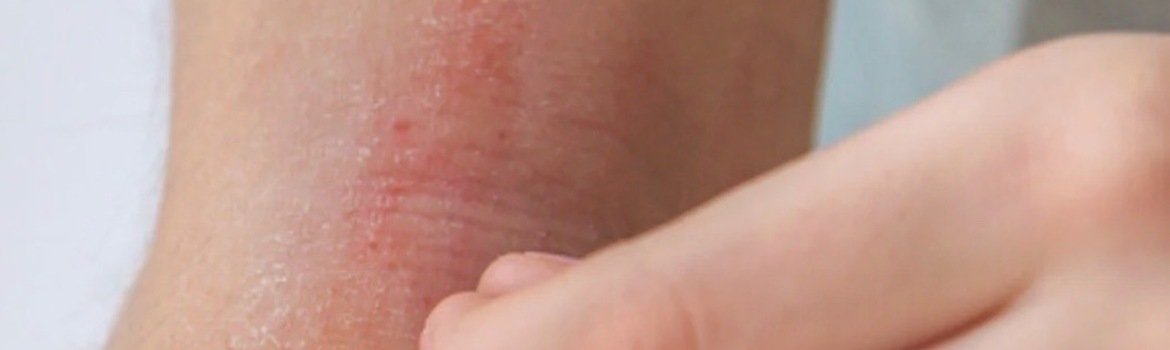 Eczema and Dry Skin: 5 Tips to Help Kids This Winter